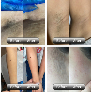 HUAMEI, precio <span class=keywords><strong>de</strong></span> fábrica, salón, láser usado, Alex ND Yag, equipo permanente, 1064NM, 755NM, máquina <span class=keywords><strong>de</strong></span> depilación láser Alejandrita - Product Image 4