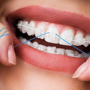 Enfile-fil dentaire pour le nettoyage des dents avec appareils orthodontiques, bridges, implants et dispositifs orthodontiques - Product Image 3