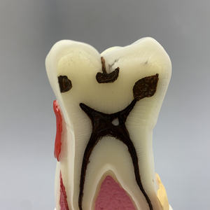 Модель стоматологической патологии кариес Пародонтит Демонстрация патологии полости рта Стоматологическое образование и обучение - Product Image 4