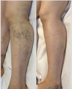 Élimination portable des varices et des télangiectasies au laser 980nm/1470nm – Traitement des capillaires et des angiomes de la <span class=keywords><strong>cerise</strong></span> - Product Image 2