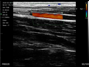 Sonda Lineal Inalámbrica de 128 Elementos DMU37 con Doppler Color para MSK/Anestesia/Vascular y Hospitalaria, en Oferta - Product Image 6