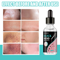 Stock 30ml sérum de tête noire saleté excès d'huile points noirs élimination de l'acné nez liquide réparateur peau purifiant masque-sérum lissant