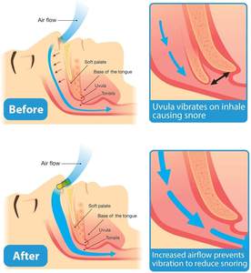 Perangkat Anti Dengkur Silikon Klip Hidung Magnetik Solusi Mendengkur Hidung Nyaman untuk Meredakan Dengkur - Product Image 3