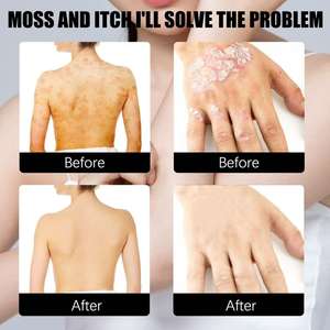 South Moon 30ml Spray Liquide Apaisant et Nourrissant Respirant pour le <span class=keywords><strong>Psoriasis</strong></span>, Soin Corporel Traditionnel Chinois à Base de Plantes - Product Image 5