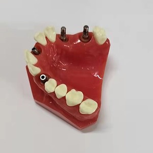 Modèle d'implant dentaire Dt 1:1, modèle anatomique en résine pour la science médicale, pour usage domestique - Product Image 2