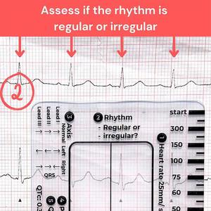 Ecg 7 Step Liniaal Ecg 7 Step Liniaal Voor Interpretatie Ecg Liniaal Kunststof Meetinstrument Transparant Ekg Remklauwen Verpleging Referentie - Product Image 4