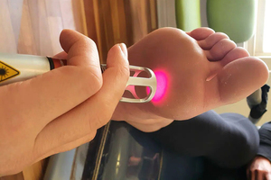 Láser de Podología en Oferta para el <span class=keywords><strong>Tratamiento</strong></span> de Hongos en las Uñas, 980nm 1064nm, Láser para Onicomicosis, Hongos en las Uñas de los Pies, con Certificación CE MDR - Product Image 6