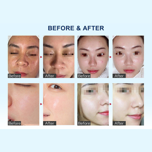 Pistola de <span class=keywords><strong>Mesoterapia</strong></span> Profesional Derma Pro de Corea, Inyector Vital para Rostro, Cuerpo, Cabeza y Labios, Blanqueamiento, Antienvejecimiento, Rejuvenecimiento de la Piel, Uso Médico - Product Image 6