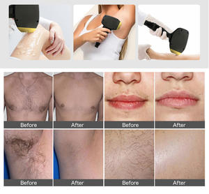 2 in 1 Alat Kecantikan Laser Penghilang Bulu Permanen Diode 808 Tanpa Rasa Sakit & Mesin Kecantikan Tato QSwitch Nd YAG Micro Carbon Skin - Product Image 6