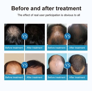 Peralatan Kecantikan Spa kecantikan terapi <span class=keywords><strong>Laser</strong></span> tingkat rendah klinik transplantasi rambut terapi untuk perawatan rambut rontok pertumbuhan rambut - Product Image 4
