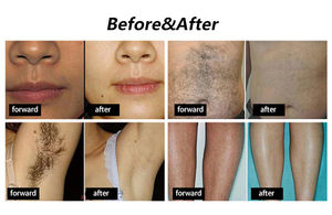 Máquina de Depilación por Electrólisis Multifuncional Ecológica, Modelo TH110, Portátil, Metálica, ABS, Nueva - Product Image 5