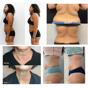 Appareil de cryothérapie Cryoskin à 3 poignées pour le remodelage corporel, machine à globes de glace - Product Image 6