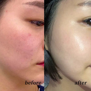 Essence réparatrice Dermacalm CHUSN |   Sérum professionnel de spa <span class=keywords><strong>pour</strong></span> apaiser les peaux sensibles, réguler le sébum, hydrater <span class=keywords><strong>et</strong></span> réparer les peaux sujettes à l'acné - Product Image 3