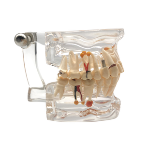 Denti trasparenti per malattie di impianti dentali modello dentista trasparente Standard patologico - Product Image 2