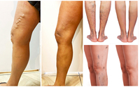 Nouvelle machine de traitement laser endoveineux à diode 980nm 1470nm EVLT 2026 pour l'élimination des varices des jambes