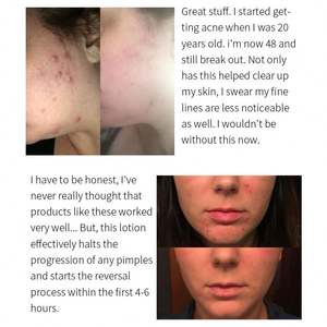 OEM Lotion calamine <span class=keywords><strong>pour</strong></span> <span class=keywords><strong>le</strong></span> séchage du corps sérum <span class=keywords><strong>pour</strong></span> éliminer <span class=keywords><strong>les</strong></span> <span class=keywords><strong>boutons</strong></span> d'acné points noirs efficace <span class=keywords><strong>sur</strong></span> <span class=keywords><strong>les</strong></span> imperfections de surface - Product Image 4