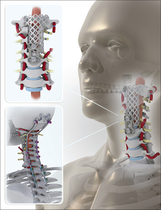 Custom <span class=keywords><strong>Mesh</strong></span> Layar Berlubang <span class=keywords><strong>Titanium</strong></span> Wire <span class=keywords><strong>Mesh</strong></span> untuk Cangkok Tulang - Product Image 6