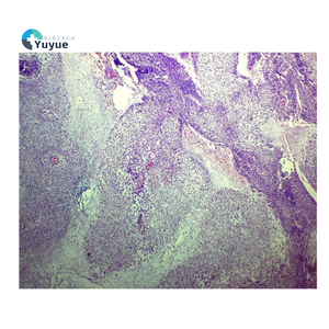 Cistadenocarcinoma seroso papilar ovárico de Educación Superior, <span class=keywords><strong>Ciencia</strong></span> Médica, sección patológica, juego de portaobjetos de microscopio de vidrio - Product Image 2