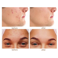 Patch Microneedle personnalisé hydrocolloïde étanche Microdart Anti-acné élimination des boutons peau visage patchs dissolvant de points noirs acné