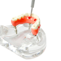 YOUYA DENTAL Nuevo Modelo de Implante Dental de Resina MX-089, 4 Implantes, Mandíbula Baja, Puente Maryland, Restauración de Sobredentadura, Tipodonto Educativo