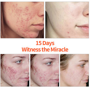Crème d'élimination de l'acné au zinc acide salicylique acné cicatrices taches contrôle de l'huile rétrécir les Pores BHA <span class=keywords><strong>AHA</strong></span> crème pour le visage contre l'acné - Product Image 6
