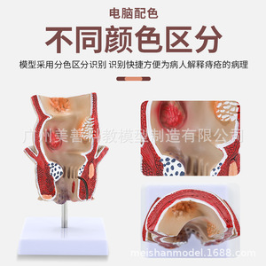 Modèle de hémorroïdes rectales et de lésions colorectales ; hémorroïdes rectales internes et externes et modèle anorectal ; pathologie rectale. - Product Image 1