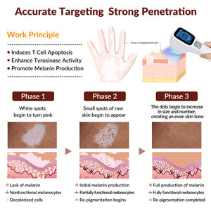 Lámpara de Vitiligo Ultravioleta de 308 nm, Láser B Zjkclasertherapy, Terapia LED, Eczema, <span class=keywords><strong>Dermatitis</strong></span> Atópica, Excimer UVB de 308 nm, 40 Mwcm2 - Product Image 3