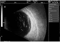 Échographe ophtalmique professionnel A-Scan Biométrie et B-Scan Imagerie OAB-5000 Innovue Opto