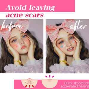 Patchs anti-acné personnalisés en forme d'étoile noire colorée et mignonne, patchs anti-boutons scintillants amusants avec acide salicylique pour le <span class=keywords><strong>visage</strong></span> - Product Image 2