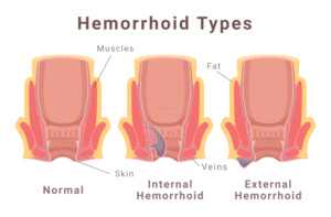 Laser ginekologi Anti Penuaan 980 1470nm kapasitansi vagina fibroid rahim perawatan fibroid klinik <span class=keywords><strong>haemorrhoid</strong></span> operasi