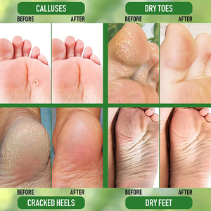 Crema Urea 40% para los pies, removedor de callos, hidratante <span class=keywords><strong>y</strong></span> rehidratación, crema para la piel gruesa, agrietada, rugosa, muerta <span class=keywords><strong>y</strong></span> seca, 281146 - Product Image 5