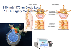 Descompresion laser diodo <span class=keywords><strong>intradiscal</strong></span> 980nm 1470nm PLDD disco spinale fisioterapia per ernia disco medico chirurgico macchina - Product Image 4
