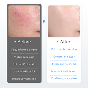 Microneedle Pimple Patch Private Label Verpakking Aangepaste Acne Behandeling Rijk aan Diverse Actieve Ingrediënten Efficiënte Reparatie - Product Image 5