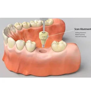 दंत चिकित्सक स्कैन के लिए दंत प्रत्यारोपण प्रणाली
