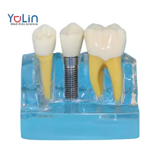 Прозрачный имплантат, Стоматологическая модель с восстановлением и патологиями для стоматологического Кабинета, модель для обучения пациента