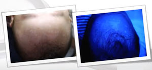 Lampe de Wood médicale à prix d'usine pour le test du vitiligo et du <span class=keywords><strong>psoriasis</strong></span>, produit de beauté et de soins personnels - Product Image 6