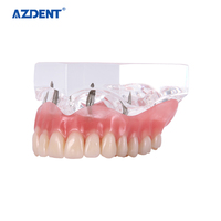 Modèle d'implant dentaire pour la restauration de prothèse dentaire avec implants supérieurs
