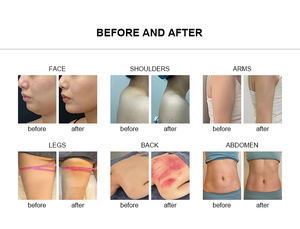 เครื่องนวดสลายไขมันแบบพกพาออลอินวัน พร้อมหัวนวด 10 แบบ สำหรับกำจัดไขมันและผ่อนคลาย - Product Image 6