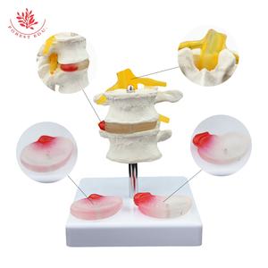 Modèle de lésion de la colonne vertébrale lombaire FRT038 modèle de pathologie vertébrale à deux segments du disque lombaire enseignement des étudiants en médecine - Product Image 3