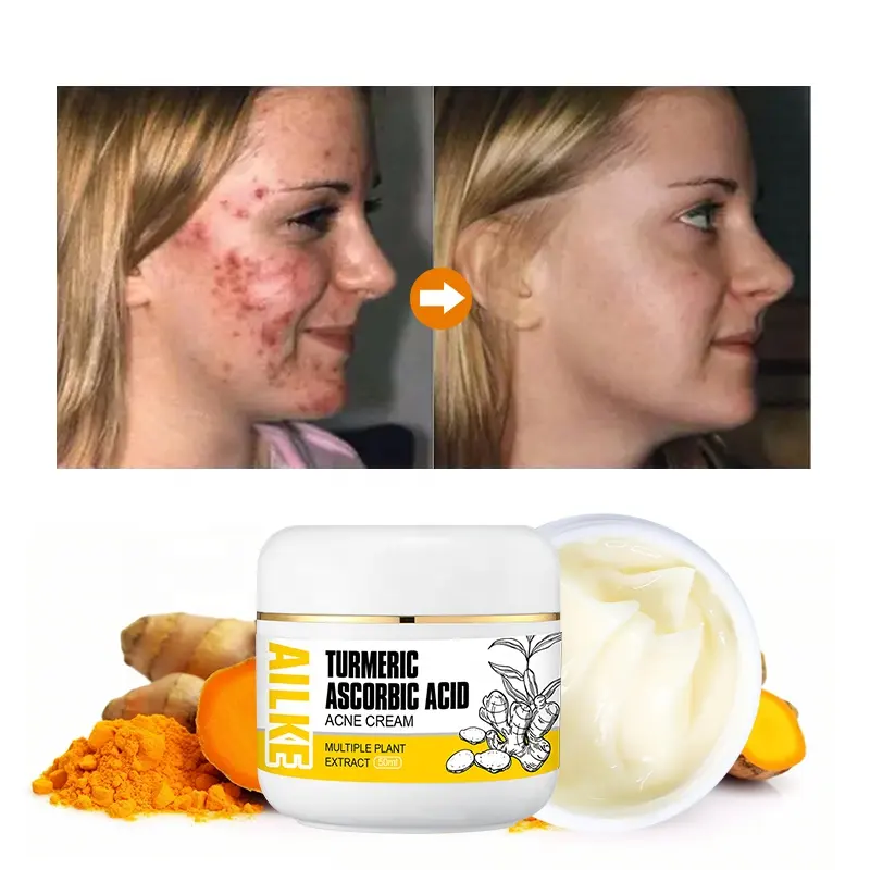 Herbal Essence Crème apaisante pour enlever les cicatrices d'acné Vegan Crème éclaircissante au curcuma 3 jours Crème anti-acné