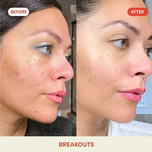 Hypochlorous Acid Spray HOCl Soothing Spray for <strong>Acne</strong> Eczema Itchy <strong>Rashes</strong> Breakout-Prone Skin Safe for All Skin Types Daily Use - Product Image 4