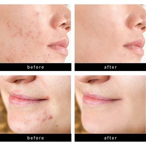 36 لاصقة جديدة لعلاج حب الشباب والبثور، رقعة هيدروكولويد مخصصة بشعار خاص، لاصقات علاجية للوجه من مورد متخصص - Product Image 3