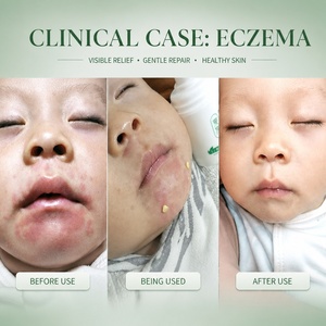 YIHE-HEALTH eczema psoriasi <span class=keywords><strong>crema</strong></span> per prurito secco screpolato - Product Image 3