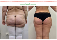 Máquina de Adelgazamiento Corporal con Liposucción Vaser de 980nm, Láser Diodo de 1470nm para Lipólisis, Endoláser para Lifting Facial