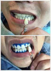 Kit Gel Sbiancante <span class=keywords><strong>per</strong></span> Denti al 44% di Perossido di Carbammide 5ML con Barriera Gengivale <span class=keywords><strong>per</strong></span> Uso Dentale Professionale Compatibile con Lampada LED Sbiancante - Product Image 6