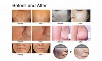 Appareil d'épilation à la lumière pulsée intense ADSS IPL Opt Laser, machine à lumière pulsée dynamique pour l'épilation et le rajeunissement de la peau