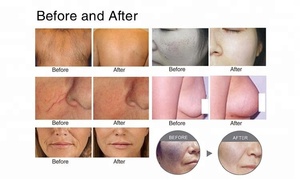 Adss cường độ cao xung <span class=keywords><strong>E</strong></span> ánh sáng IPL OPT tẩy lông bằng laser năng động xung ánh sáng máy cho tẩy lông trẻ hóa da - Product Image 5