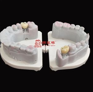 Impianto dentiere il modo migliore per trattare la perdita dei denti. Non danneggiare i denti adiacenti, evitare vicino al carico di forza del morso dei denti - Product Image 1