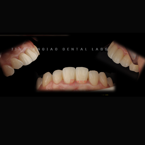 Fournitures pour prothèses dentaires Produits dentaires Placage en porcelaine Restauration de prothèses fixes <span class=keywords><strong>Sourire</strong></span> <span class=keywords><strong>parfait</strong></span> - Product Image 4