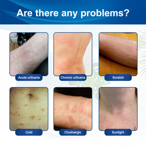Etiqueta privada Urticaria aguda urticaria crónica rasguño colinérgica luz solar alivio hinchazón picazón eczema tratamiento crema - Product Image 6